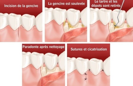 Lambeaux d'assainissement