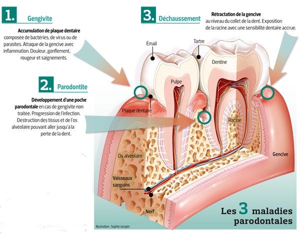 Gingivite et Parodontite