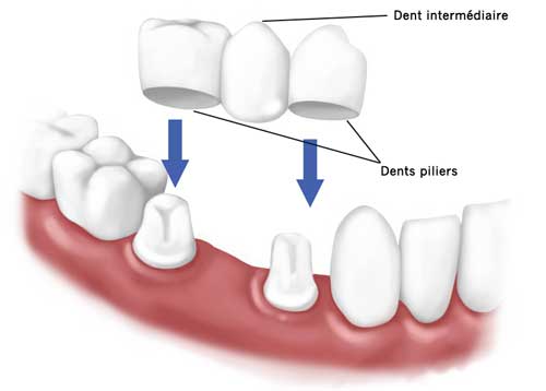 Les Bridges Dentaires