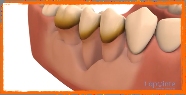 La maladie parodontale