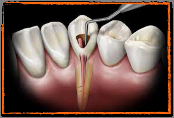 Le traitement endodontique