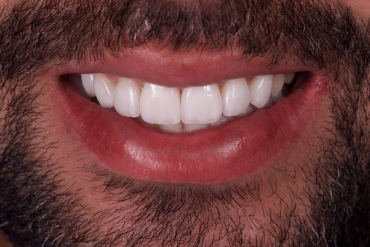 Les Facettes Dentaires par des Spécialistes de la Dentisterie Esthétique à  Marseille dans le 13008 - Cabinet esthétique dentaire Maupassant